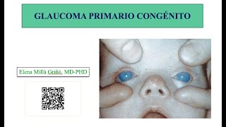 Glaucoma Primario Congénito [upl. by Flanna]