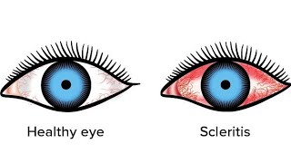 ScleritisEpiscleritis  in very easy way eyedisorders scleritis episcleritis shalakyatantra [upl. by Kimble]