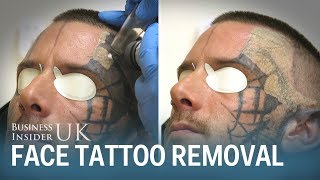 Watch This Man Have His Face Tattoo Removed From Laser Surgery  Business Insider [upl. by Eniretak]