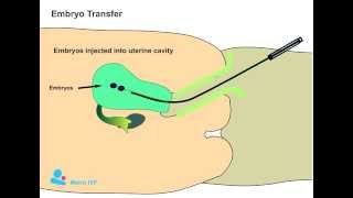 Embryo Transfer procedure [upl. by Steffie786]