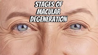 Stages of Macular Degeneration Patient Education Series maculardegeneration [upl. by Behre]