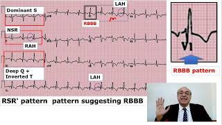 EKG Trainer Case 2 Answer CME internalmedicine ecg محاضراتباطنة امراضباطنة [upl. by Kwapong]