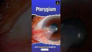 What Is A Pterygium  What is Pterygium in Hindi Pterygium PterygiuminHindi shorts eye [upl. by Asseralc575]