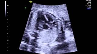 Tetralogy of Fallot 5 chamber view [upl. by Gerrald]