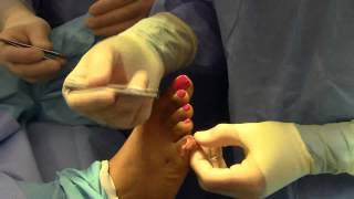 Hammer Toe 5th Digit Surgery  Dr Nagler  Spanish [upl. by Calan36]