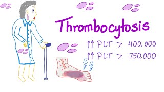 Thrombocytosis Primary and Secondary  Why Is My Platelet Count High  Hematology [upl. by Anasus]