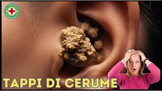 🔴 Tappi di Cerume Giganti Cause Sintomi e Trattamenti 🩺 Info Salute 👔 Dr MAX [upl. by Aelahc]