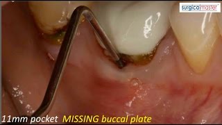 How to handle an 11mm pocket on the buccal [upl. by Atila]