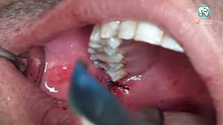 انكسار ابرة التخدير أثناء تخدير الفك Anesthesia needle fracture during mandibular nerve anesthesia [upl. by Ternan]