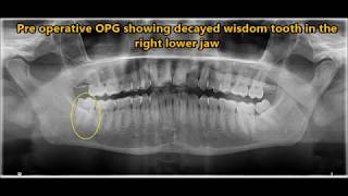 Extraction of decayed lower 3rd molar [upl. by Jarib]