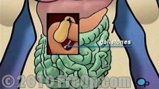 Gallbladder Removal Laparoscopic PreOp® Patient Education Feature [upl. by Yntrok]