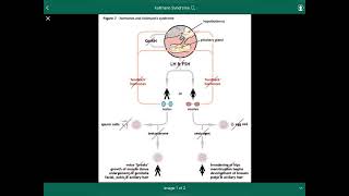 Kallmann Syndrome  متلازمة كولمان [upl. by Naimed]