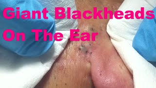 Giant Blackheads  Part I [upl. by Aynwad]