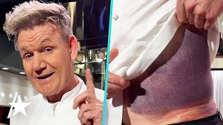 Gordon Ramsay Reveals MASSIVE Bruise After Bike Accident [upl. by Noyk]