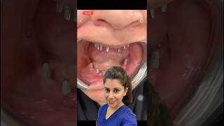 Implants Supported Denture  Fixed Teeth  DrPratibha shorts dental viral implant trending [upl. by Ingunna]