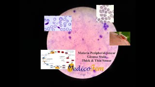 Peripheral Smear  Plasmodium falciparum  Thick and Thin Blood Smear  Giemsa Stain  Malaria [upl. by Halimaj191]