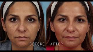 PicoSure Laser Skin Revitalization [upl. by Heiney270]