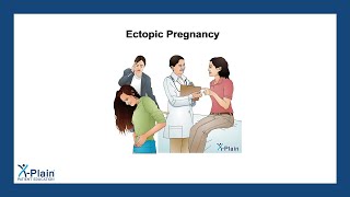 Ectopic Pregnancy [upl. by Amadas]