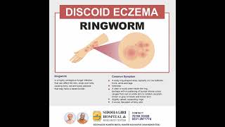 What is Discoid EczemaRingworm [upl. by Hujsak816]