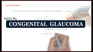 Congenital Glaucoma  ophthalmology  NEXT PG [upl. by Akinohs]