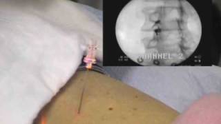 Lumbar Facet Joint Injection  PalmHarborOrthocom [upl. by Starlin]