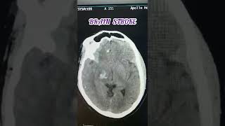 Brain Stroke  Brain Hemorrhage  Hemorrhagic Stroke [upl. by Bohman]