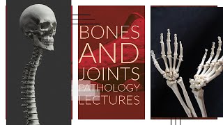 BONES AND JOINTS PATHOLOGY lecture 7 OSTEOID OSTEOMA and OSTEOBLAASTOMA differences and quick review [upl. by Adnirak]