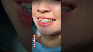 BRACES ORTHODONTICS [upl. by Ahtanamas]