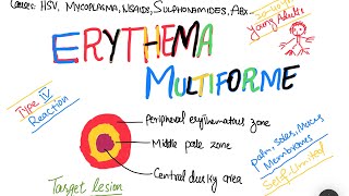 Erythema Multiforme EM causes symptoms treatment  skin disorder [upl. by Olecram]