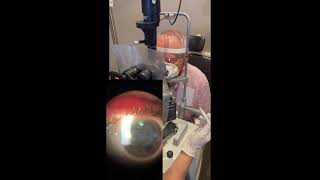 Durysta Implantation at the Slit Lamp [upl. by Farr603]