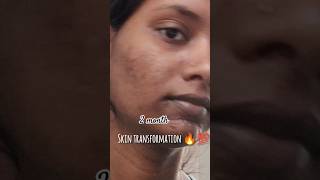 💯🔥 SKIN TRANSFORMATION JOURNEY skintransformation skintransformationjourney skintreatment acne [upl. by Seiuqram120]