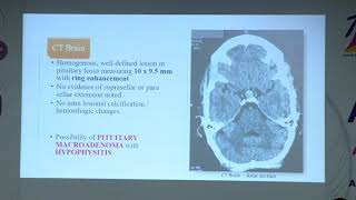 AIOC2020 HydePark II Dr SIVAGAMI NACHIAPPAN A RARE CASE OF HYPOPHYSITIS IN A PITUITARY ADENOMA PRESE [upl. by Annohs]