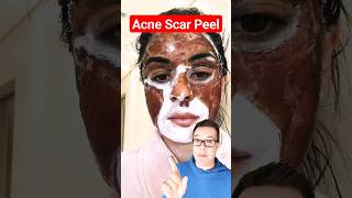 DRAMATIC CHEMICAL PEEL  Phenol Peel For Acne Scars shorts [upl. by Eckmann]