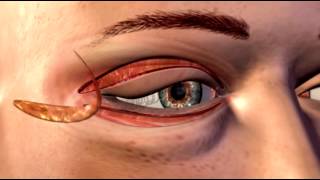 Cosmetic Eye and Eyelid Surgery  3D Medical Animation  ABP © [upl. by Haeckel]