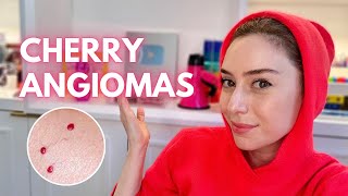 Cherry Angiomas How To Treat Them  Demo  Dr Shereene Idriss [upl. by Letizia622]