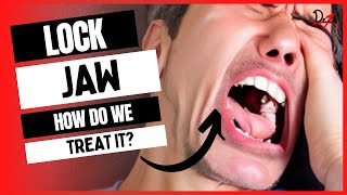 How do we treat Lock Jaw Acute Dislocation of Jaw [upl. by Attah]