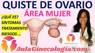 QUISTE DE OVARIO ¿QUÉ ES SÍNTOMAS TRATAMIENTO RIESGOS  Ginecología y Obstetricia [upl. by Sion682]