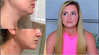 MY CHIN LIPO EXPERIENCE  COST PROCESS BEFORE amp AFTERS [upl. by Gans581]