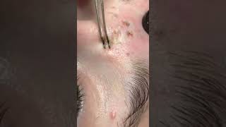 Blackheads Popping amp Blackhead Removal Videos 2022 [upl. by Mozes]