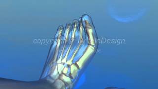 B 070 Hallux Valgus OP  PAL 169  B 070 Hallux Valgus OP  PAL 169 [upl. by Ahab112]