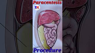 Paracentesis procedures medicineknowledgehindi short [upl. by Ester]