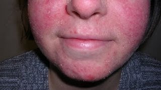 How to Treat Facial Eczema DermTVcom Epi 479 [upl. by Nonnahc]