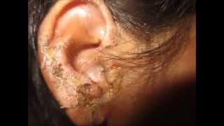 Impetigo Head Lice Nits [upl. by Acinad]