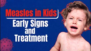 Measles Symptoms Treatment and Vaccination – Know all about it in this video [upl. by Athena]