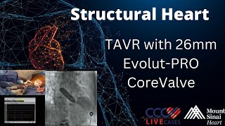 TAVR with 26mm EvolutPRO CoreValve  May 8 2018 [upl. by Fogg789]