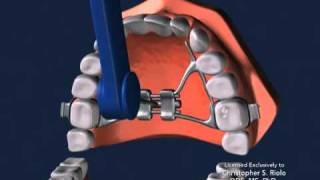 Seattle Orthodontist Dr Christopher Riolo Banded Expander RPE [upl. by Jada]