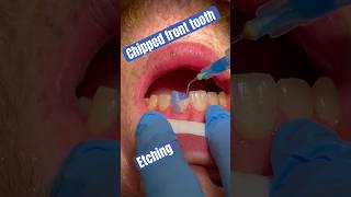 Chipped tooth Composite preparation [upl. by Aicinod]