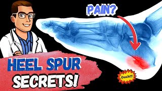 BEST Heel Spur Pain Treatments Causes Exercises amp Remedies [upl. by Kaazi934]