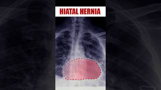 Hiatal Hernia radiology doctor anatomy [upl. by Enajyram67]