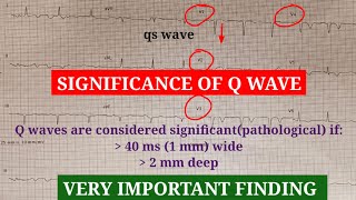 Pathological q wave diagnosis and ECG interpretation [upl. by Terb352]